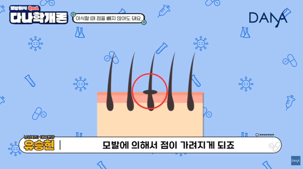 머리에 점이 있어도 모발이식 할 수 있나요? 관련 이미지 9