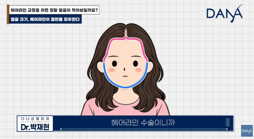 넙데데한 얼굴이 고민이라면? 상위 1% 원장님이 말하는 진짜 안면 축소술 관련 이미지 17
