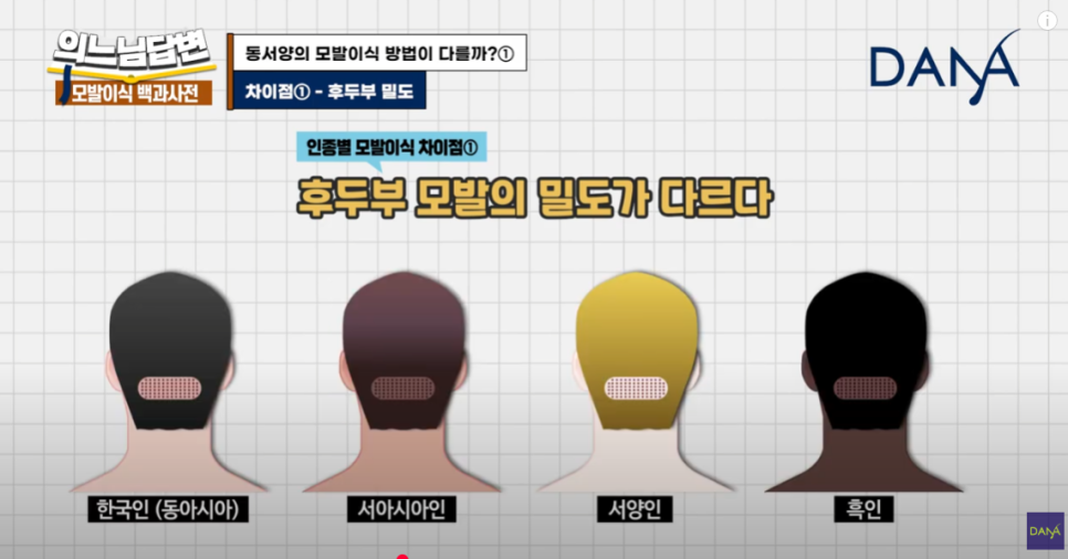 How Is Hair Transplantation Different by Race? image 5