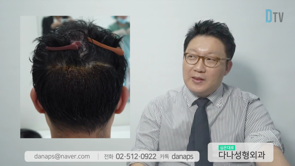 If You Want Natural Results, Long-Hair Non-Shaven Non-Incisional Hair Transplantation image 9