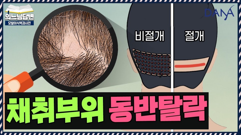 Hair Transplant Donor-Site Shedding That Can Occur After Hair Transplant Surgery image 1