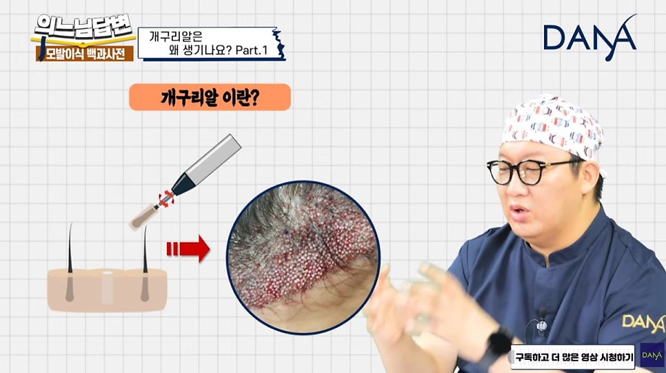 Why Frog-Egg-Like Bumps Appear After Hair Transplant_Series 1 image 4