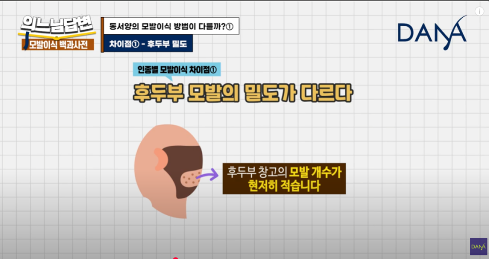 How Is Hair Transplantation Different by Race? image 4
