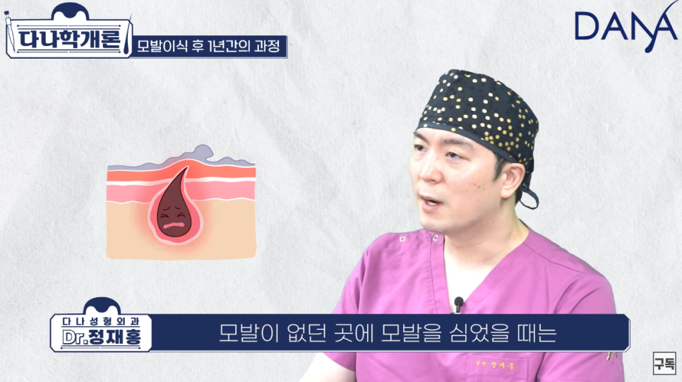 모발이식 1년후 (수술후 머리카락이 자라나는 과정) 관련 이미지 9