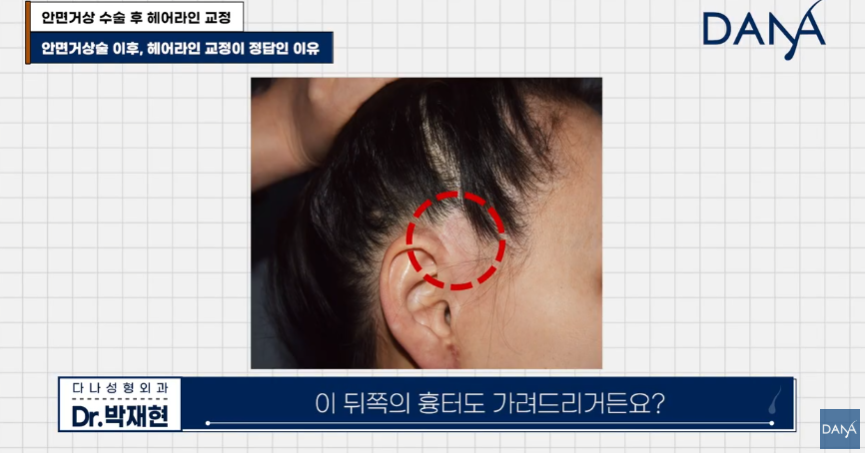 안면거상술 후 흉터와 헤어라인 변형, 자연스럽게 해결하는 방법 관련 이미지 20