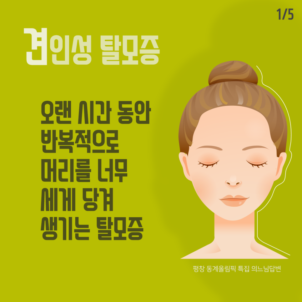 머리를 세게 묶어 오는 견인성 탈모 관련 이미지 2