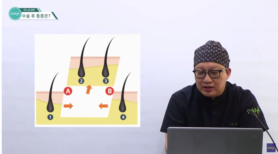 How to Reduce Pain After Hair Transplant Surgery image 4