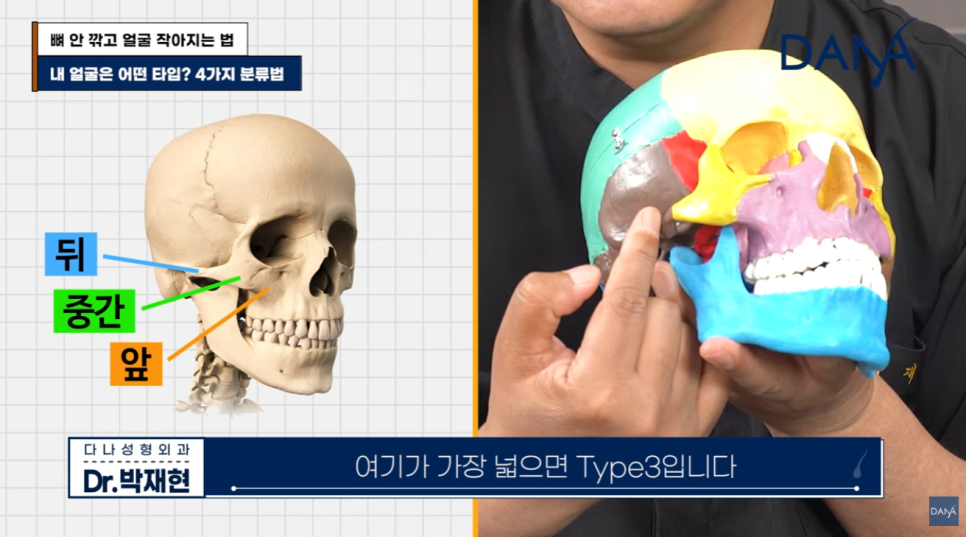 뼈 안 깎고 얼굴 작아지는 법? 광대 수술 효과 없는 관련 이미지 6