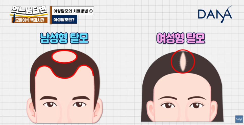 여성형 탈모, 두피문신vs모발이식? 관련 이미지 2