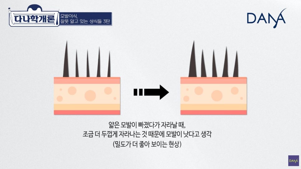 모발이식에 관해 잘못 알려진 상식들_3편 관련 이미지 16