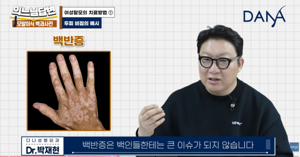 여성형 탈모, 두피문신vs모발이식? 관련 이미지 6