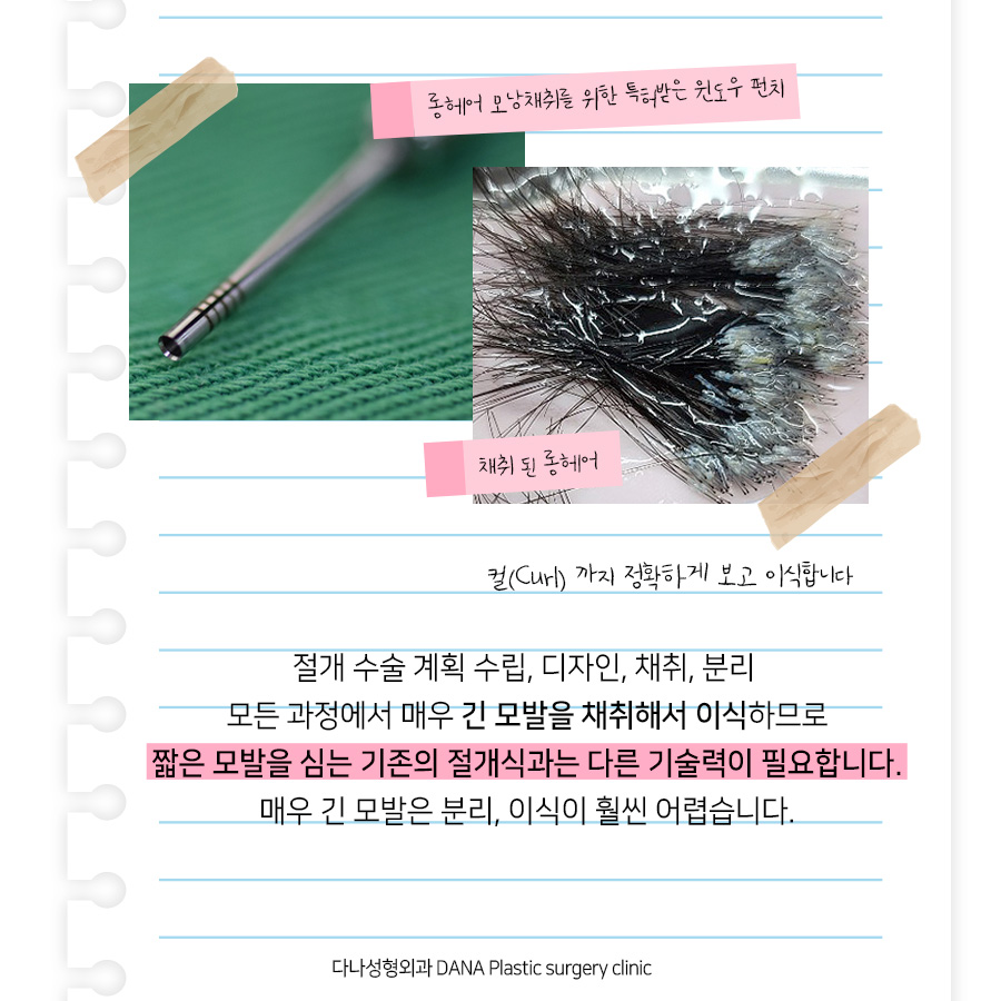 Preview Long Hair No-Shave Hair Transplant: No Visible Signs After Surgery and Back to Work the Next Day? image 7