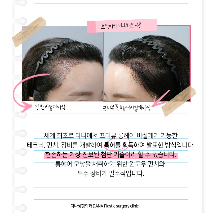 Preview Long Hair No-Shave Hair Transplant: No Visible Signs After Surgery and Back to Work the Next Day? image 3