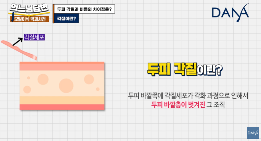 머리 잘 감아도 비듬 생기는 뜻밖의 원인! 두피 각질 차이 및 해결법 관련 이미지 2