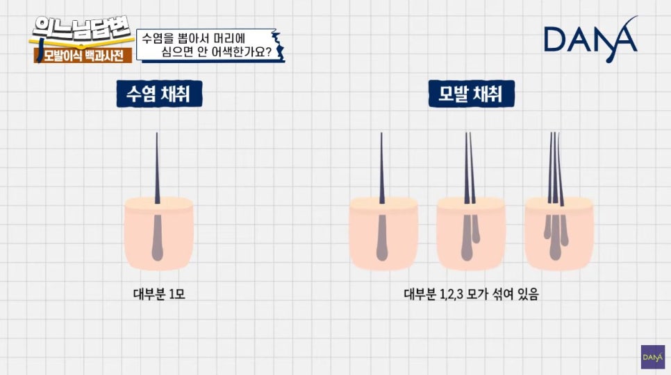 수염이식 머리카락으로 심어도 될까? 관련 이미지 2