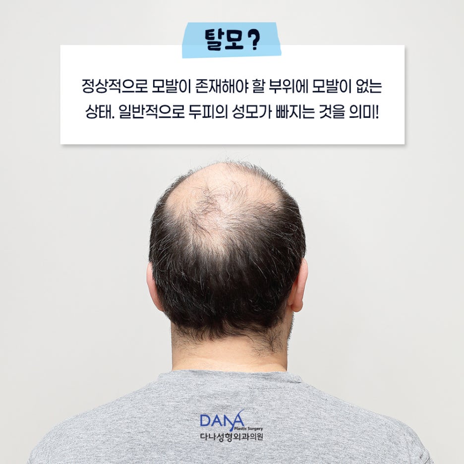 탈모의 원인과 적절한 치료 방법 관련 이미지 3