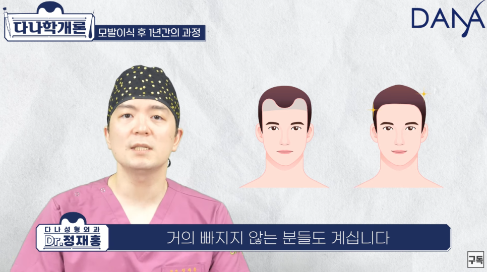 모발이식 1년후 (수술후 머리카락이 자라나는 과정) 관련 이미지 7