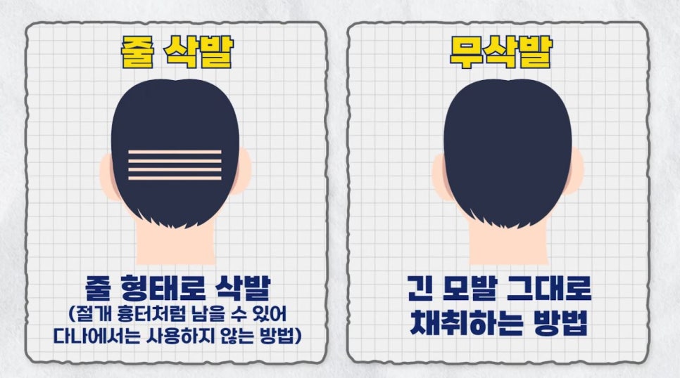 모발이식 수술 시 삭발 종류 관련 이미지 13