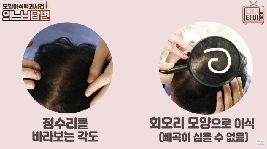 정수리모발이식수술 성공률을 높이는 방법은? 관련 이미지 3