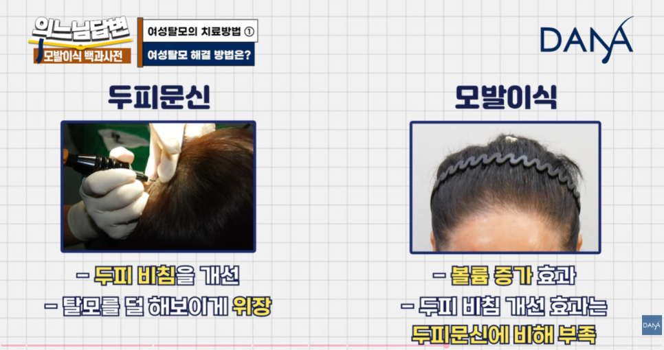 여성형 탈모, 두피문신vs모발이식? 관련 이미지 10