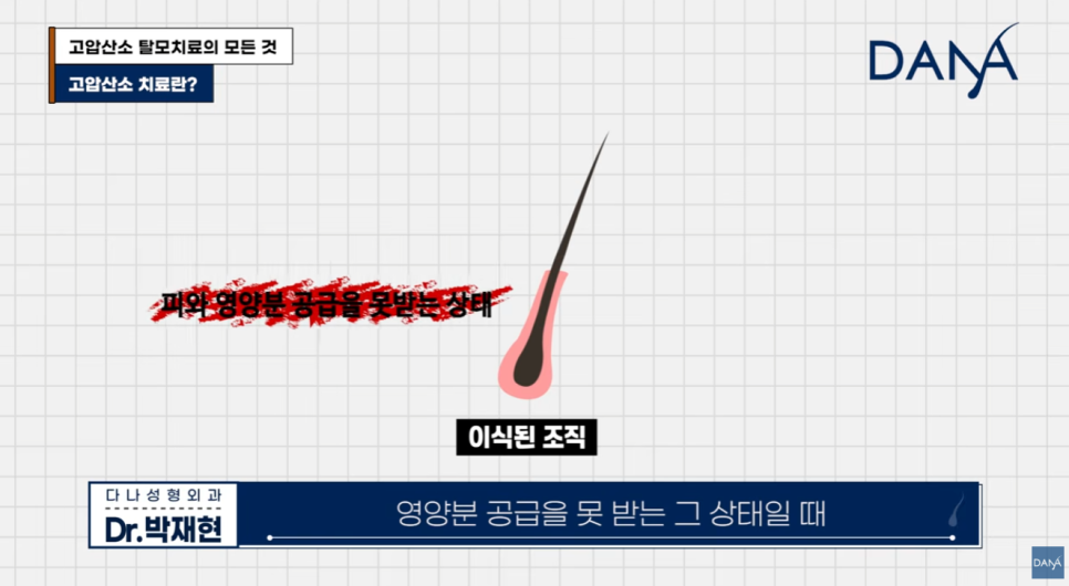 고압산소 탈모치료 돈 낭비일까? 부작용부터 효과까지 총정리 관련 이미지 3