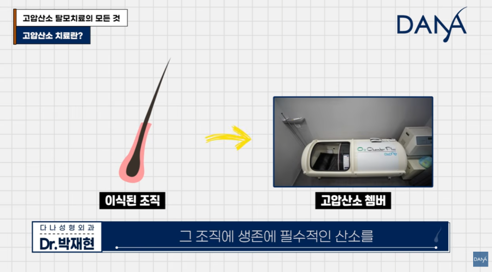 고압산소 탈모치료 돈 낭비일까? 부작용부터 효과까지 총정리 관련 이미지 4