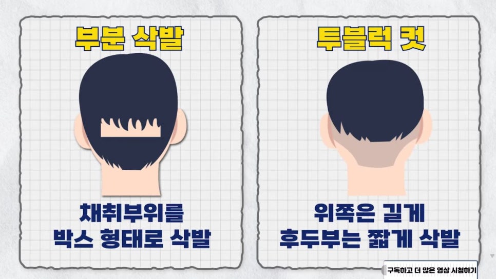 모발이식 수술 시 삭발 종류 관련 이미지 12