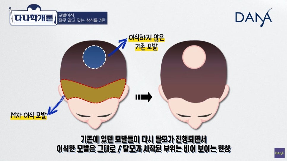 모발이식에 관해 잘못 알려진 상식들_3편 관련 이미지 6