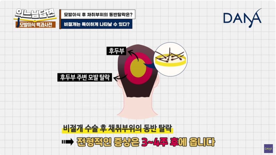 Hair Transplant Donor-Site Shedding That Can Occur After Hair Transplant Surgery image 4