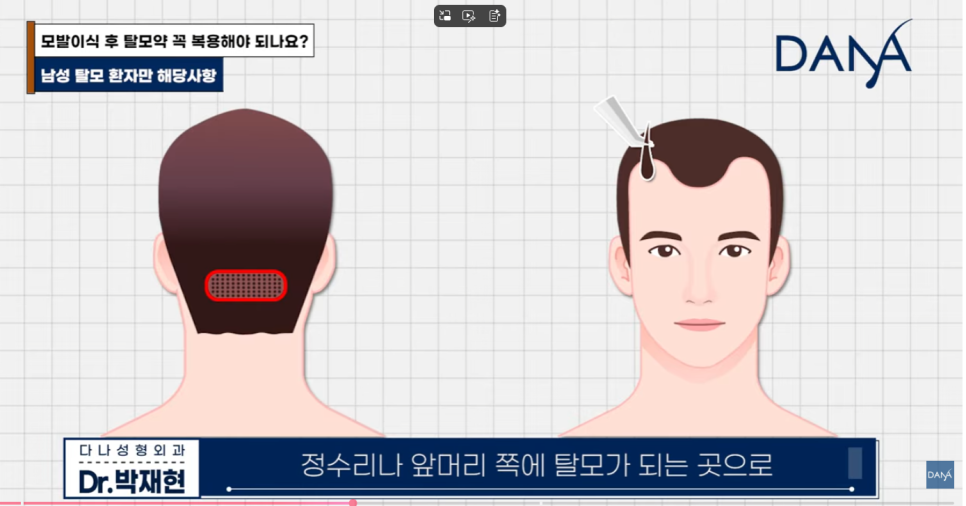 Is Taking Hair Loss Medication Essential After Hair Transplant? What Happens If You Don’t Take Propecia or Avodart image 5