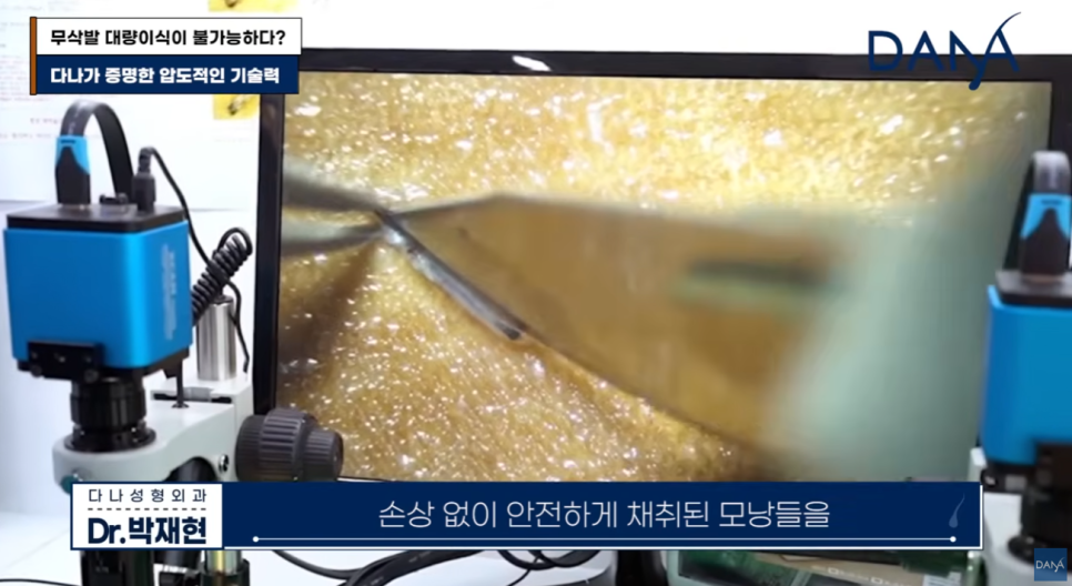 무삭발 모발이식이르 3000모 대량이식 가능할까? 생착률 높이는 진짜비밀 관련 이미지 17