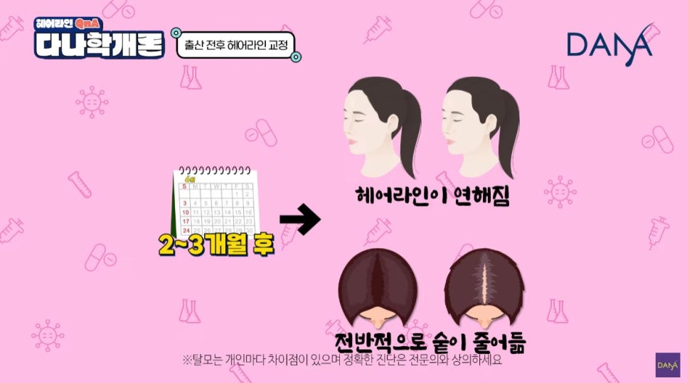 산후탈모 출산 후 생기는 이유와 헤어라인교정 시기는? 관련 이미지 5