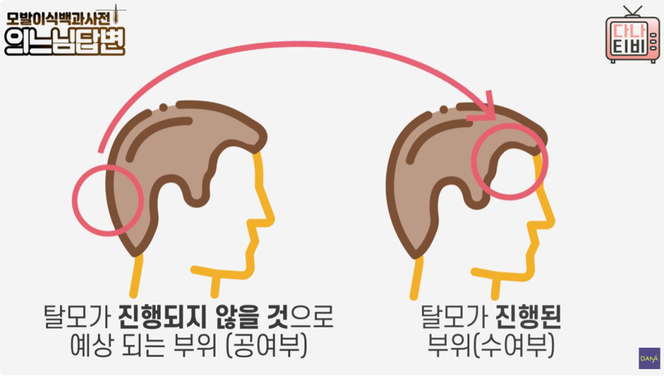 모발이식수술 후 심은 이식모는 빠질까? 관련 이미지 3
