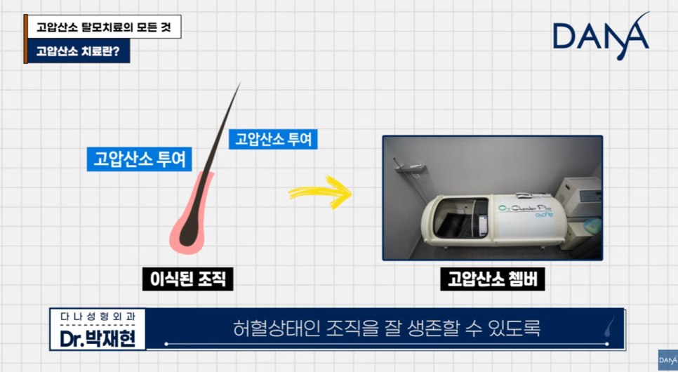 고압산소 탈모치료 돈 낭비일까? 부작용부터 효과까지 총정리 관련 이미지 6