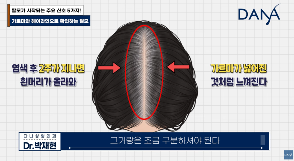 혹시 나도 탈모일까? 초기 증상 5가지와 10초 자가진단법 관련 이미지 18