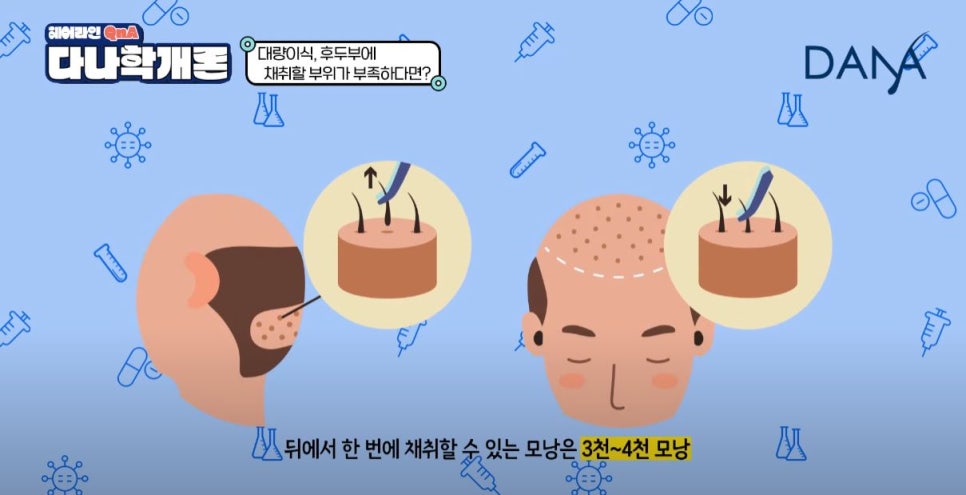 대량이식, 채취할 모발이 부족하면 어떻게 해야할까? 관련 이미지 3
