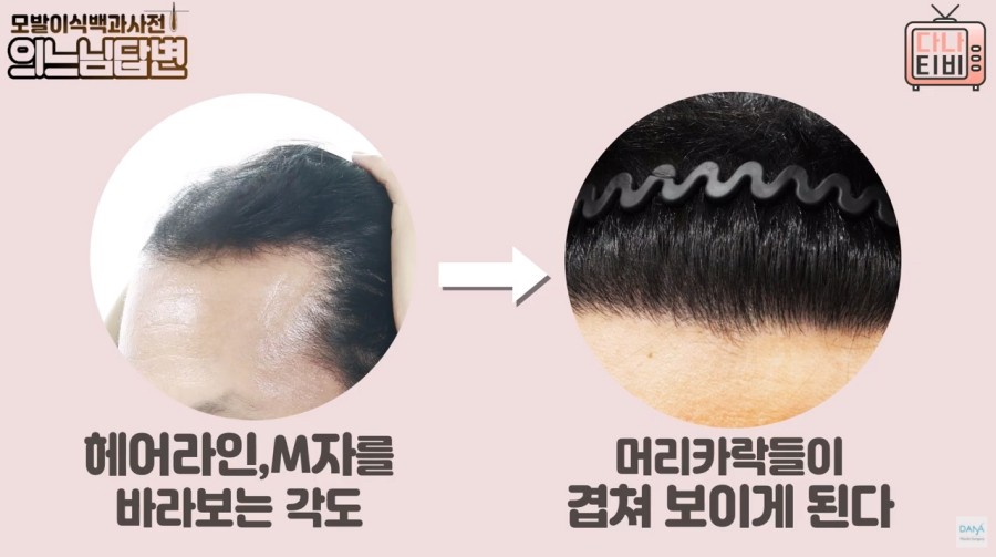 정수리모발이식수술 성공률을 높이는 방법은? 관련 이미지 2