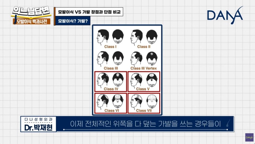 모발이식 VS 가발, 가발의 장점과 단점은? 관련 이미지 2