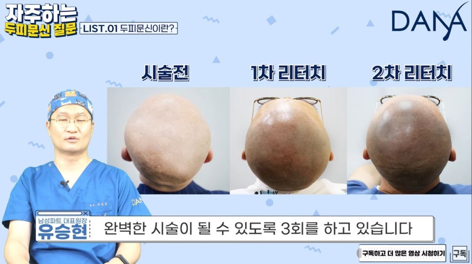 What Are the Effects of Tattooing for Hair Loss? (feat. What Is Scalp Micropigmentation?) image 5