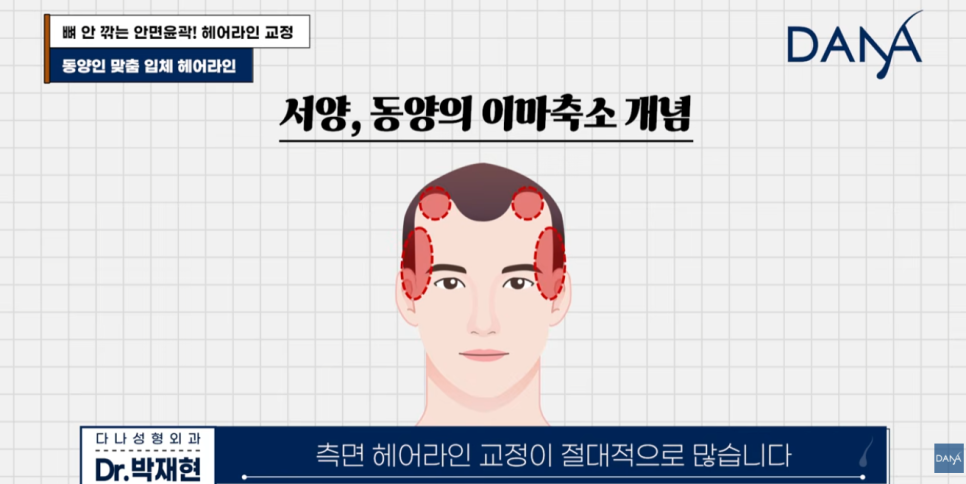 동양인vs서양인 이마 차이, 한국인에게 헤어라인 교정이 필수인 이유 관련 이미지 5