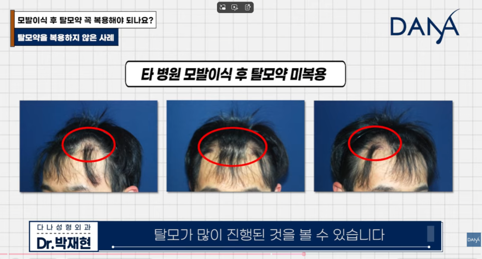 Is Taking Hair Loss Medication Essential After Hair Transplant? What Happens If You Don’t Take Propecia or Avodart image 8