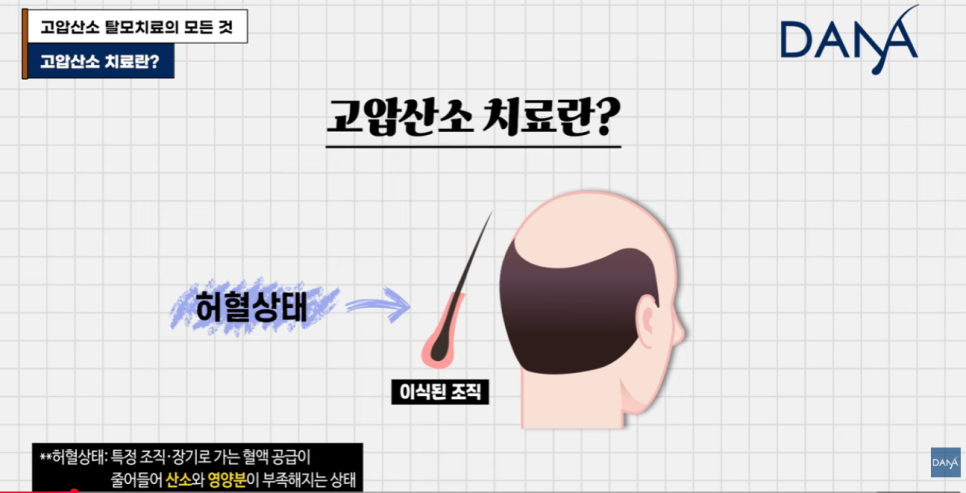 고압산소 탈모치료 돈 낭비일까? 부작용부터 효과까지 총정리 관련 이미지 1