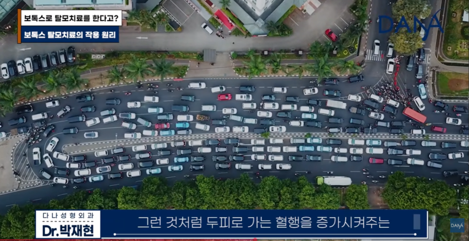 여성 탈모 치료, 먹는 약 대신 두피 보톡스 맞아야 하는 이유 관련 이미지 10