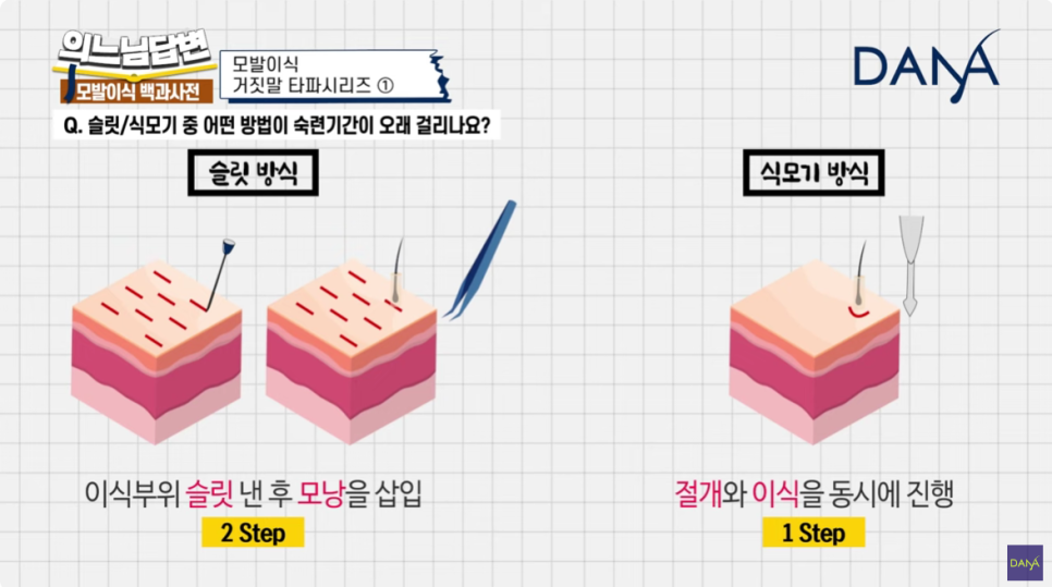 Hair Transplant Truth or Lie ① image 5