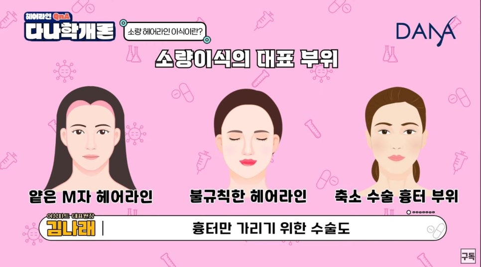 헤어라인교정 소량(적은모수)으로도 가능할까 관련 이미지 4