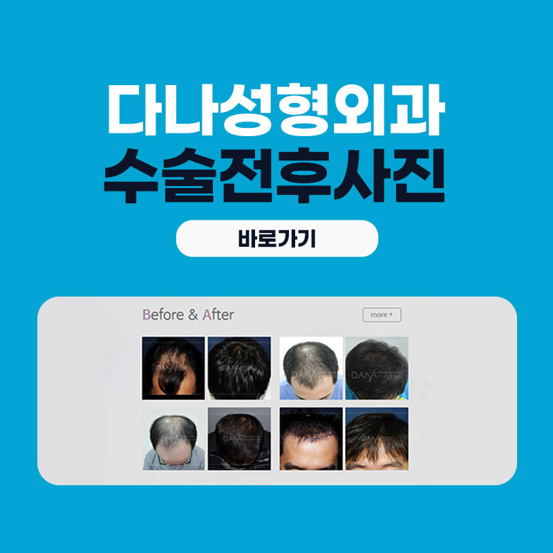 대량이식, 채취할 모발이 부족하면 어떻게 해야할까? 관련 이미지 12