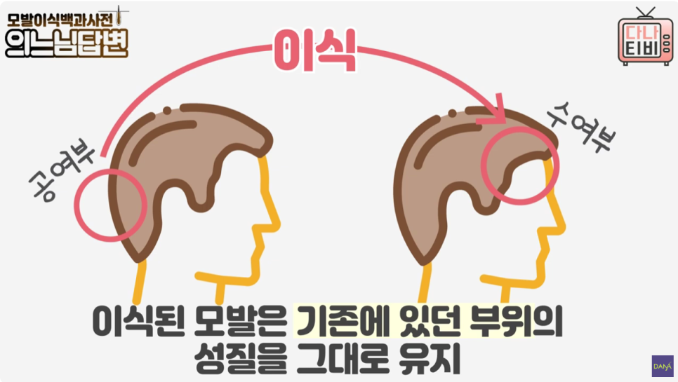 모발이식수술 후 심은 이식모는 빠질까? 관련 이미지 4