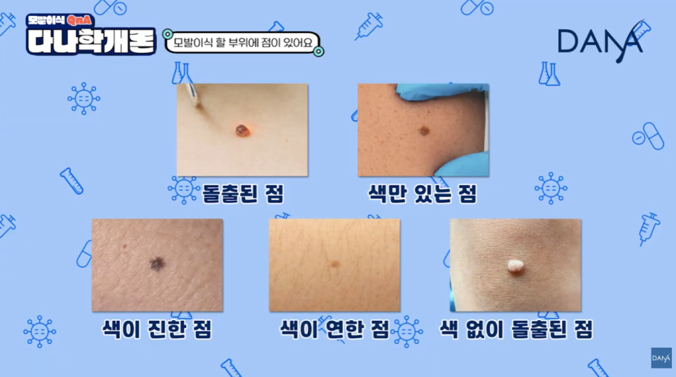 머리에 점이 있어도 모발이식 할 수 있나요? 관련 이미지 3