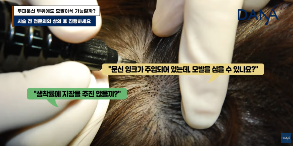 Is Hair Transplantation Possible After Scalp Micropigmentation? image 6