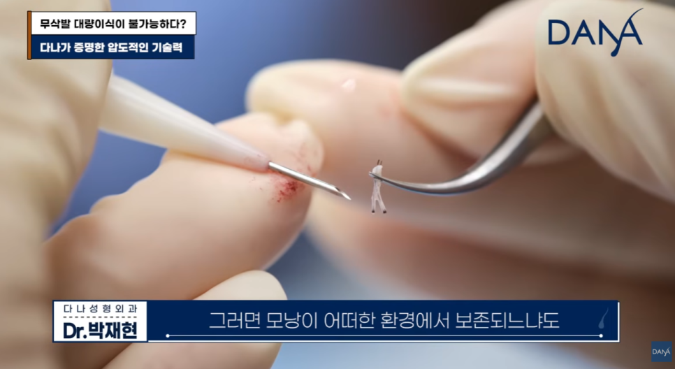 무삭발 모발이식이르 3000모 대량이식 가능할까? 생착률 높이는 진짜비밀 관련 이미지 9